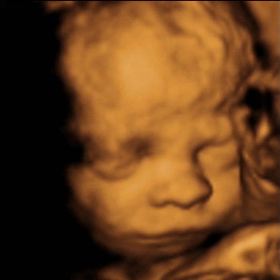 3D ultrasound before WombView baby portrait
